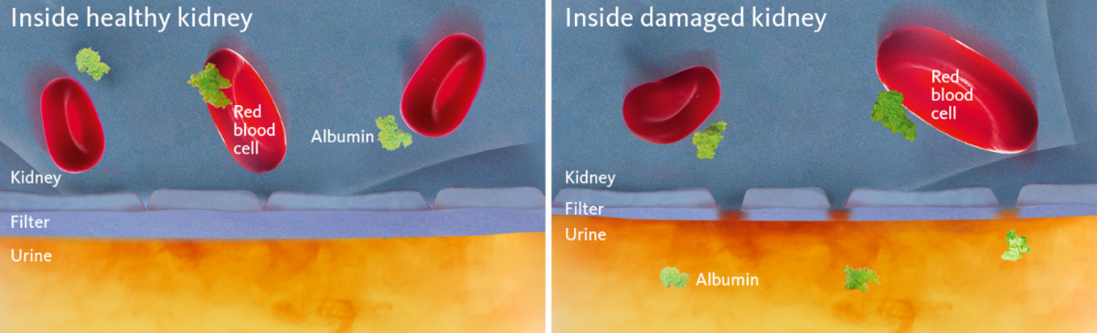 [MEA.COM-en MEA (english)] •	Schematic and simplified view of a healthy and a damaged kidney membrane with the latter illustrating the cause of albuminuria.