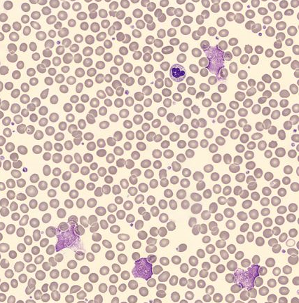 Fig 2 Digital imaging (by a DI-60) revealing smudge cells.