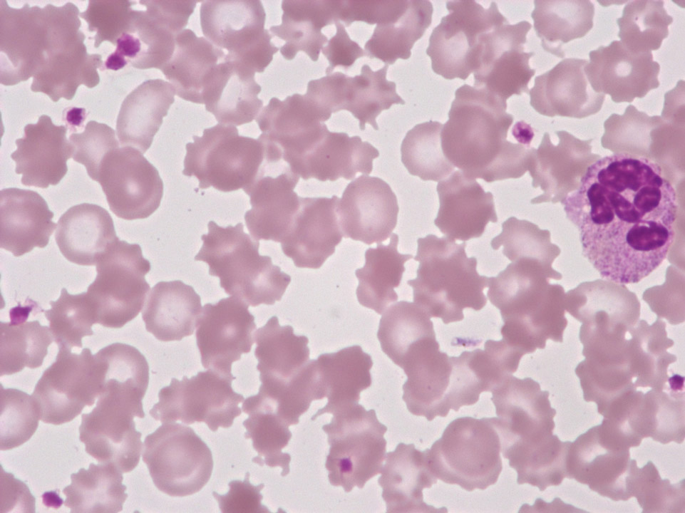 Acanthocytes Acanthocytes