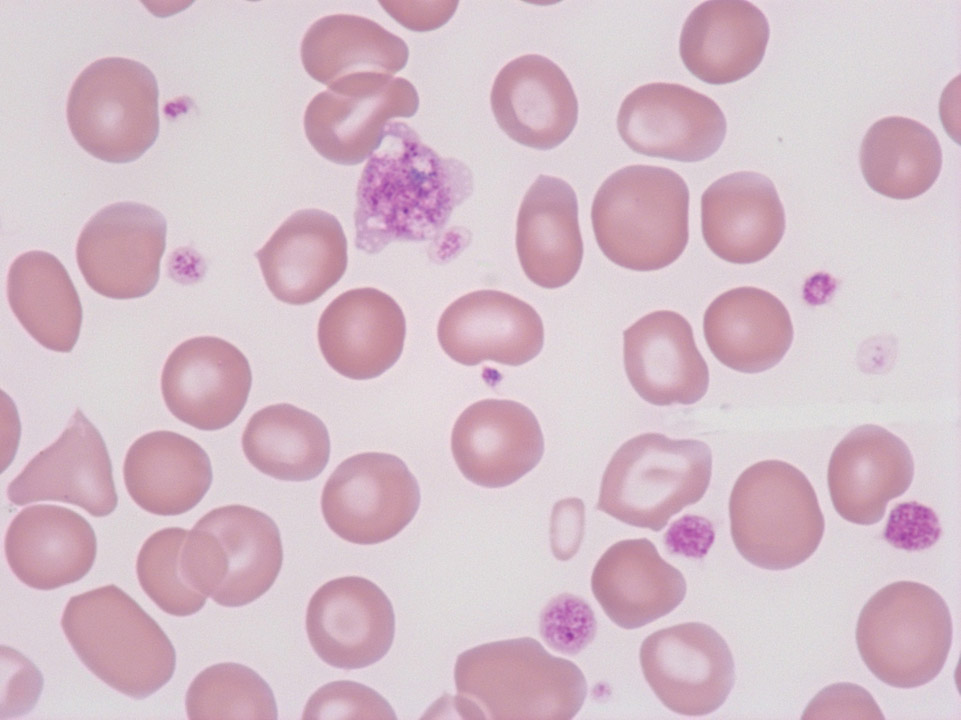 Giant platelet Giant platelet