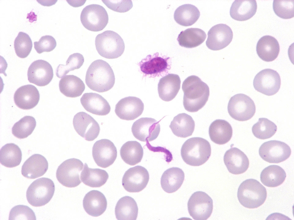 Abnormal platelets