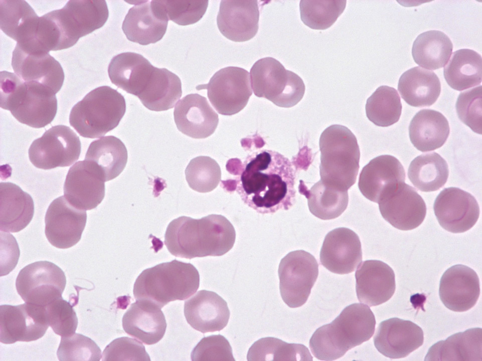 Accumulation of platelets on granulocytes Accumulation of platelets on granulocytes