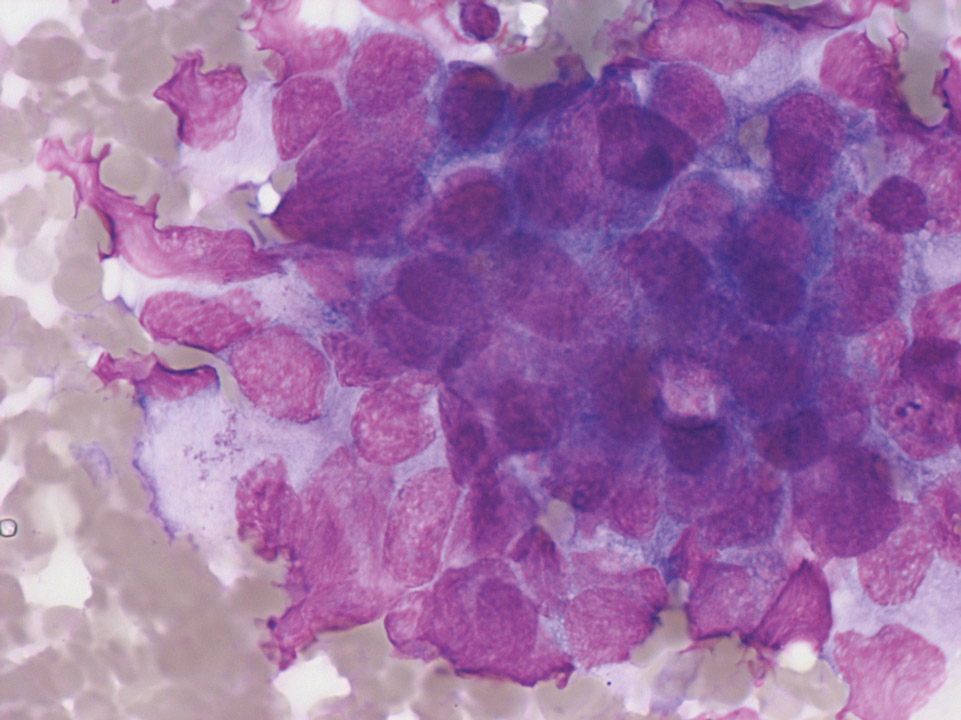 Colorectal carcinoma cells in bone marrow