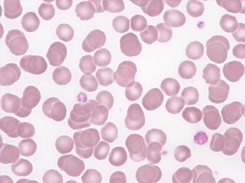 Thrombocytopenia and platelet anisocytosis Thrombocytopenia and platelet anisocytosis