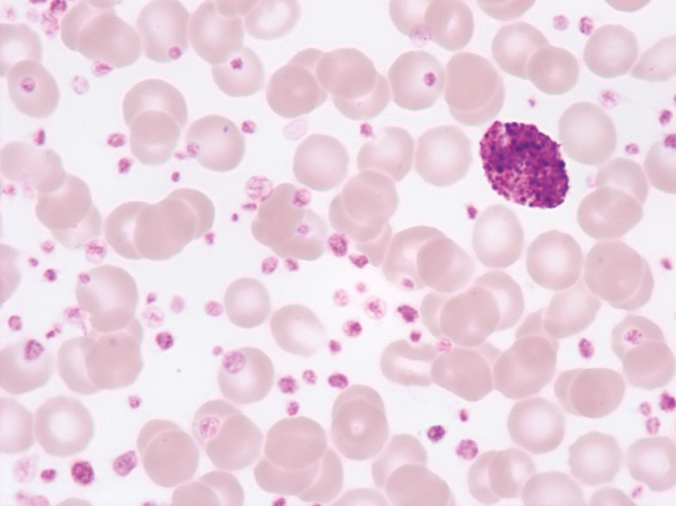 Extreme thrombocytosis in chronic myelogenous leukaemia