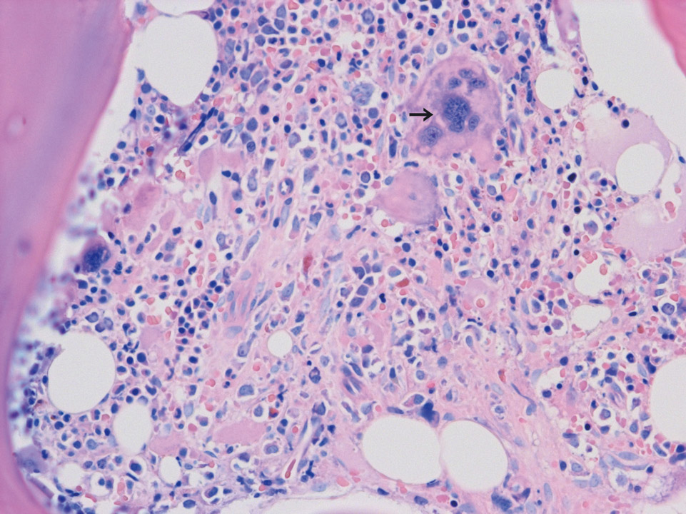 Bone marrow histology showing prefibrotic stage of PMF Bone marrow histology showing prefibrotic stage of PMF