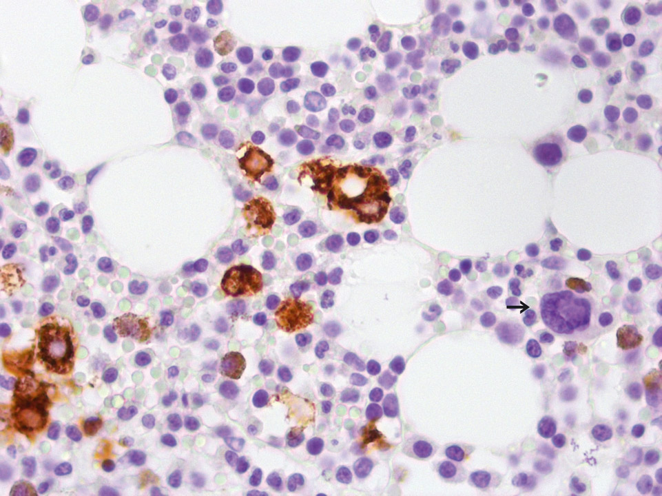 Bone marrow histology of a patient with breast cancer Bone marrow histology of a patient with breast cancer