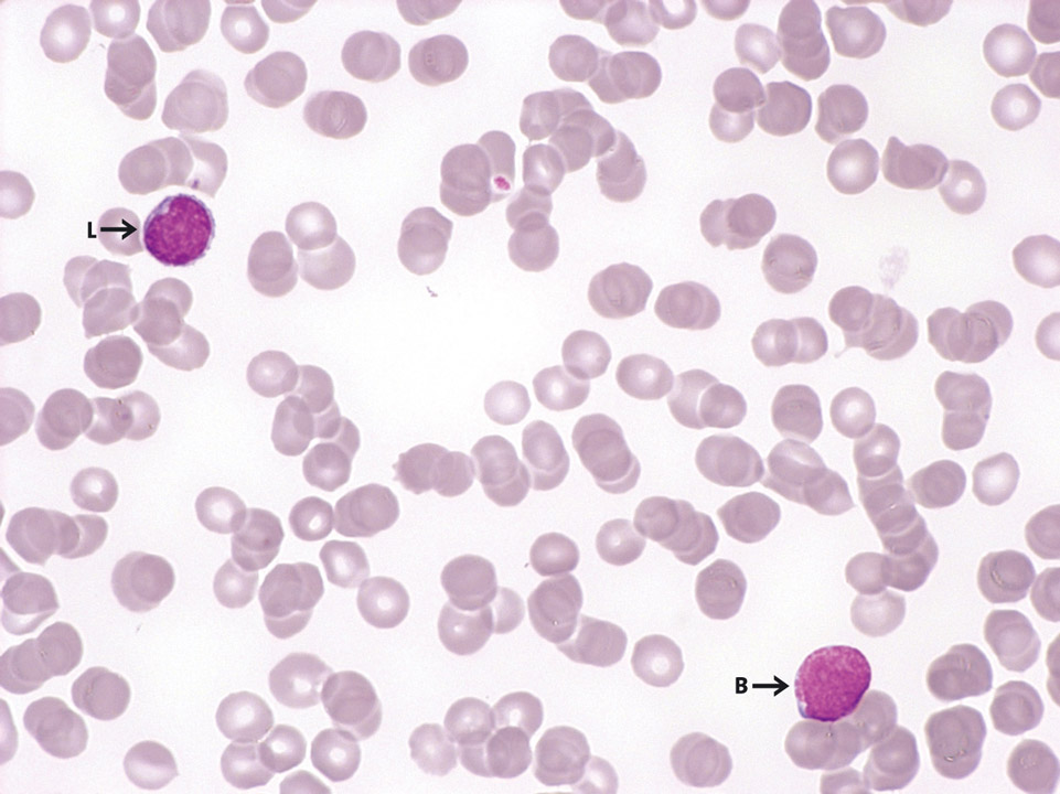 Blast cells in peripheral blood