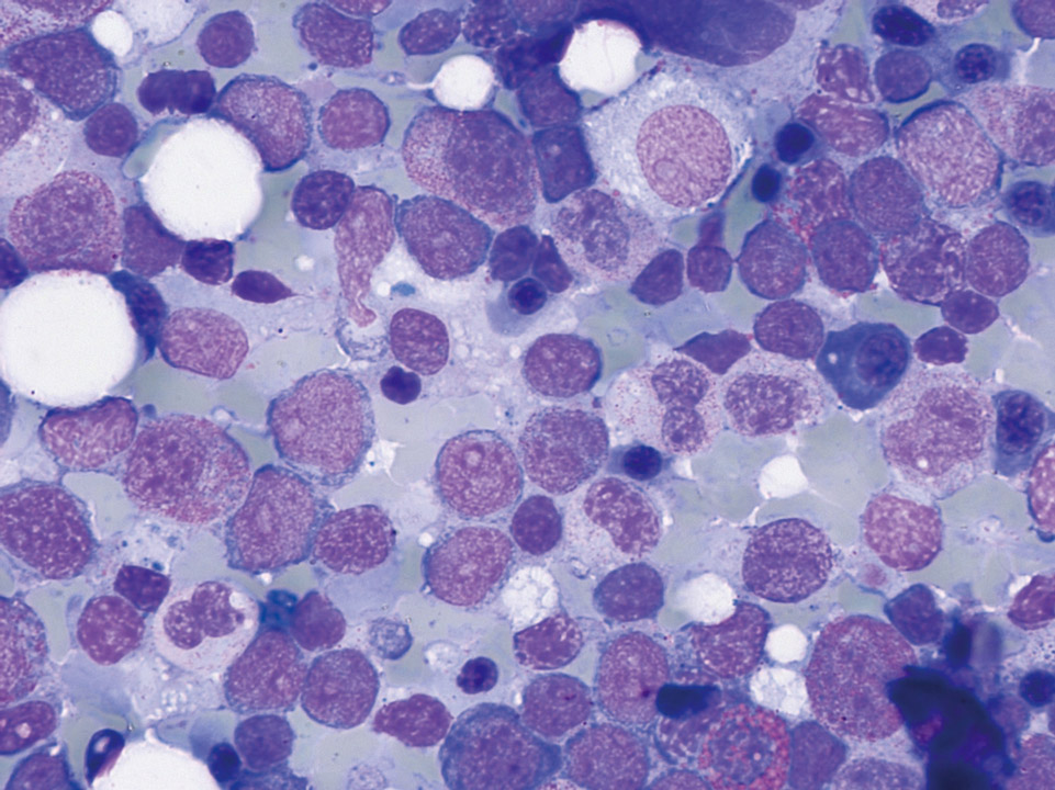 Blasts in bone marrow cytology