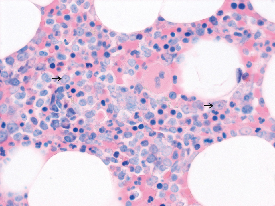 Bone marrow histology with blast cells Bone marrow histology with blast cells