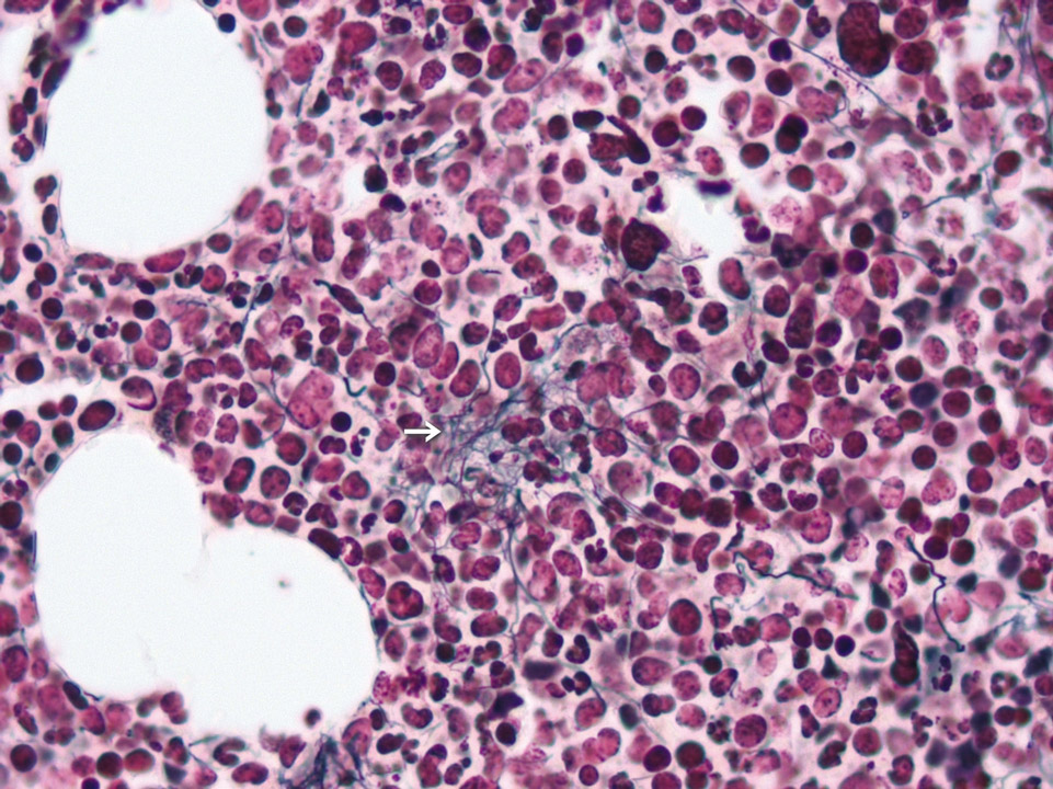 Bone marrow histology showing blasts Bone marrow histology showing blasts