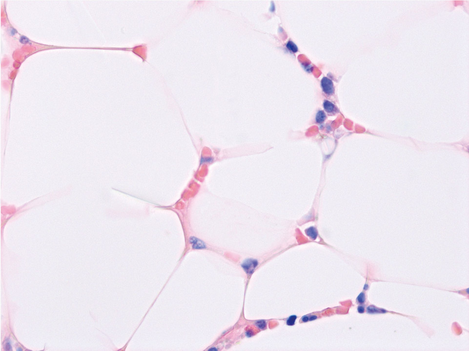 Bone marrow histology of a patient with severe aplastic anaemia Bone marrow histology of a patient with severe aplastic anaemia
