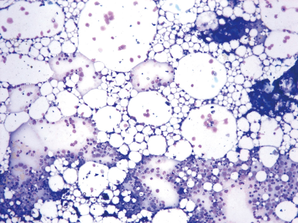 Bone marrow cytology of a patient with aplastic anaemia Bone marrow cytology of a patient with aplastic anaemia