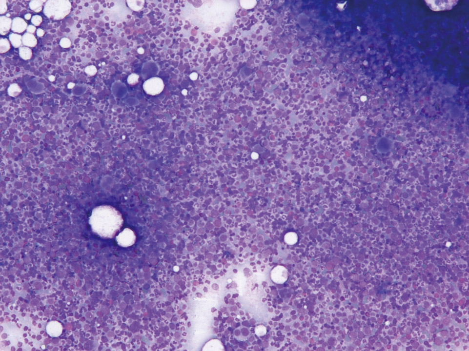 Bone marrow cytology of a patient with CML Bone marrow cytology of a patient with CML
