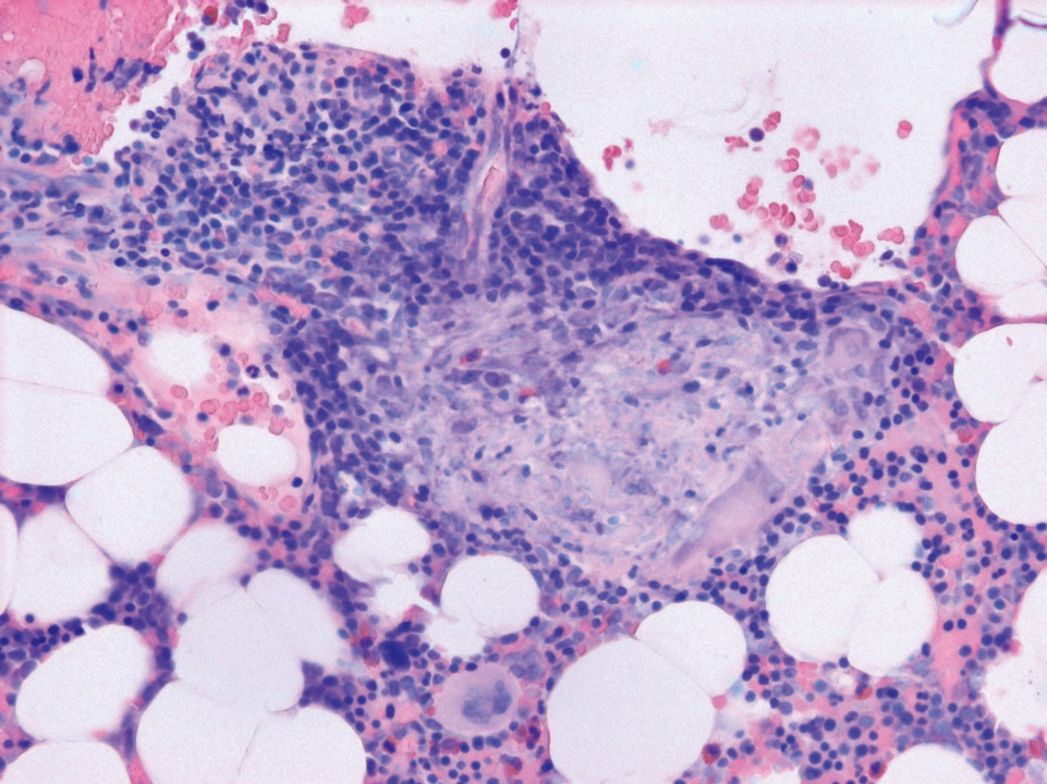 Bone marrow histology of a patient with sarcoidosis Bone marrow histology of a patient with sarcoidosis