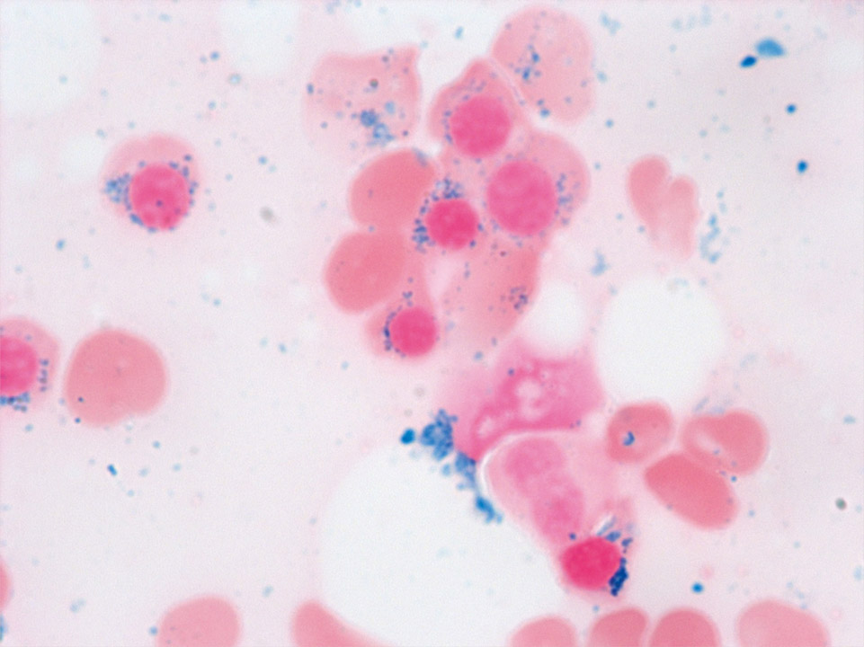 Bone marrow cytology showing predominantly ringed sideroblasts Bone marrow cytology showing predominantly ringed sideroblasts