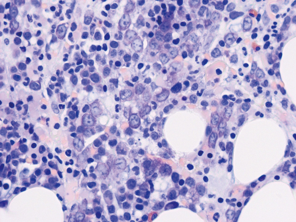 Bone marrow histology showing altered bone marrow architecture and pronounced dysplasia Bone marrow histology showing altered bone marrow architecture and pronounced dysplasia