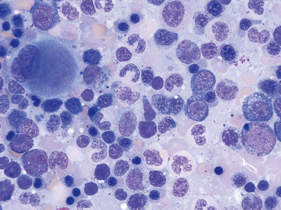 Bone marrow cytology showing dysplastic changes in all cell lineages Bone marrow cytology showing dysplastic changes in all cell lineages