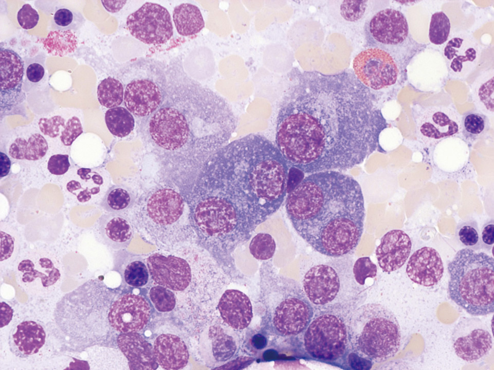 Bone marrow cytology of a patient with multiple myeloma