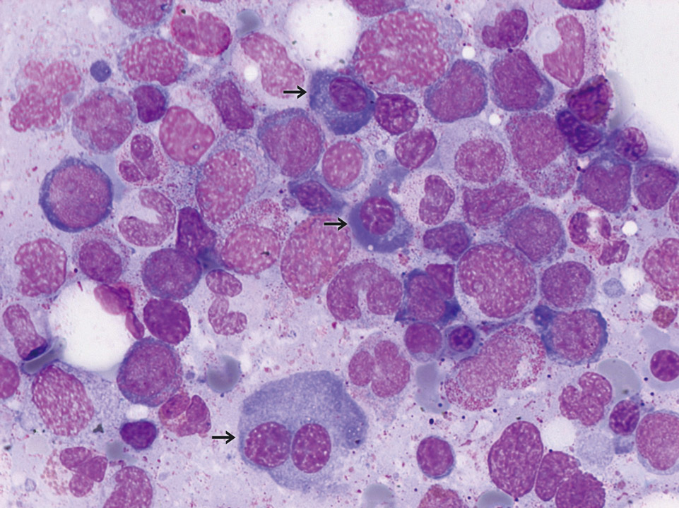 Bone marrow cytology of a patient with CMML Bone marrow cytology of a patient with CMML