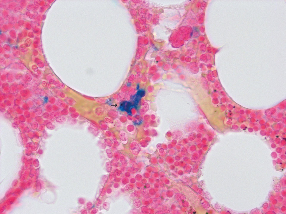 Iron accumulation in bone marrow Iron accumulation in bone marrow