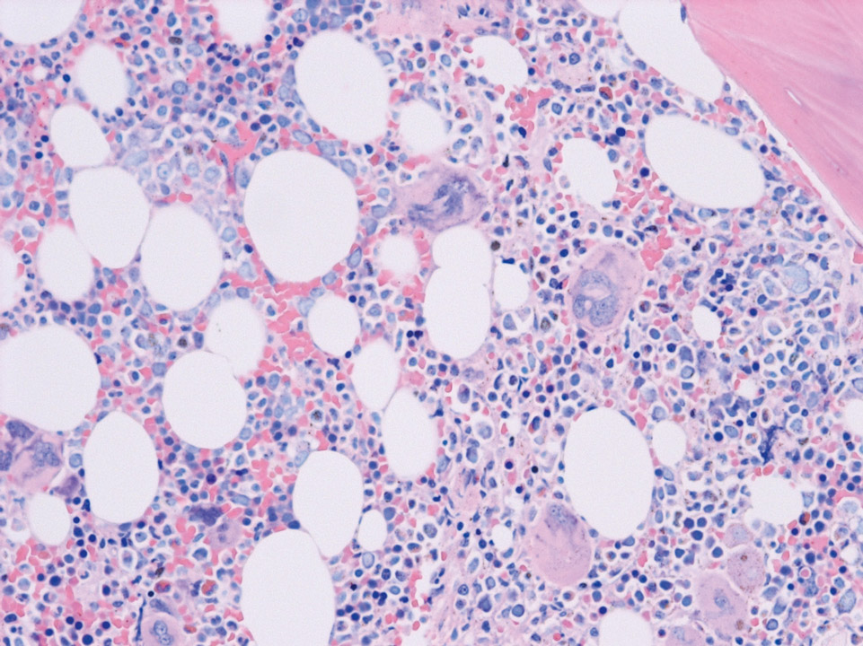 Bone marrow histology with an increased number of megakaryocytes Bone marrow histology with an increased number of megakaryocytes