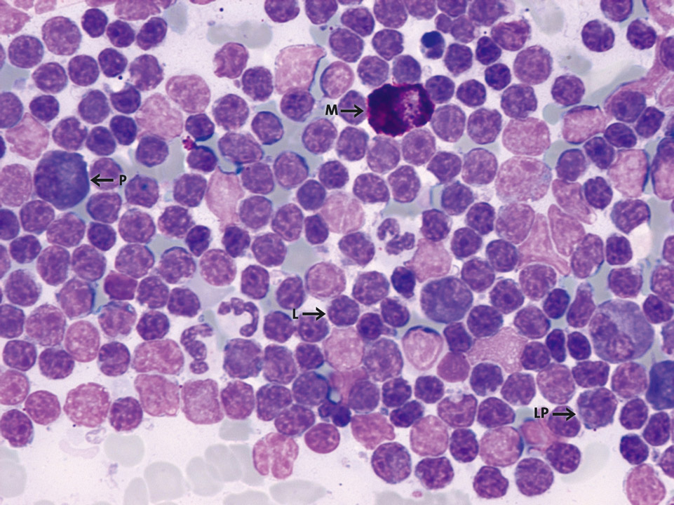 Bone marrow cytology of a patient with immunocytoma Bone marrow cytology of a patient with immunocytoma
